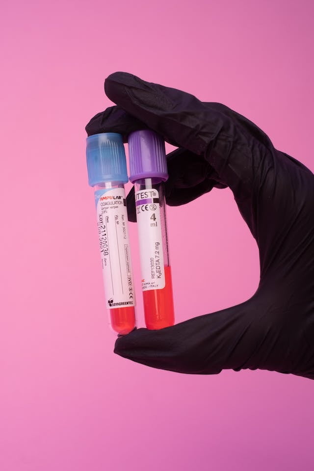 Análisis de Hierro en Sangre con Laboratorio de Análisis Clínicos NSB.